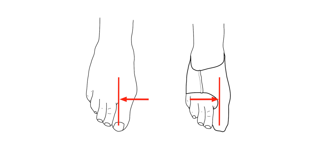 Image of feet before and after bunion sleeve correction