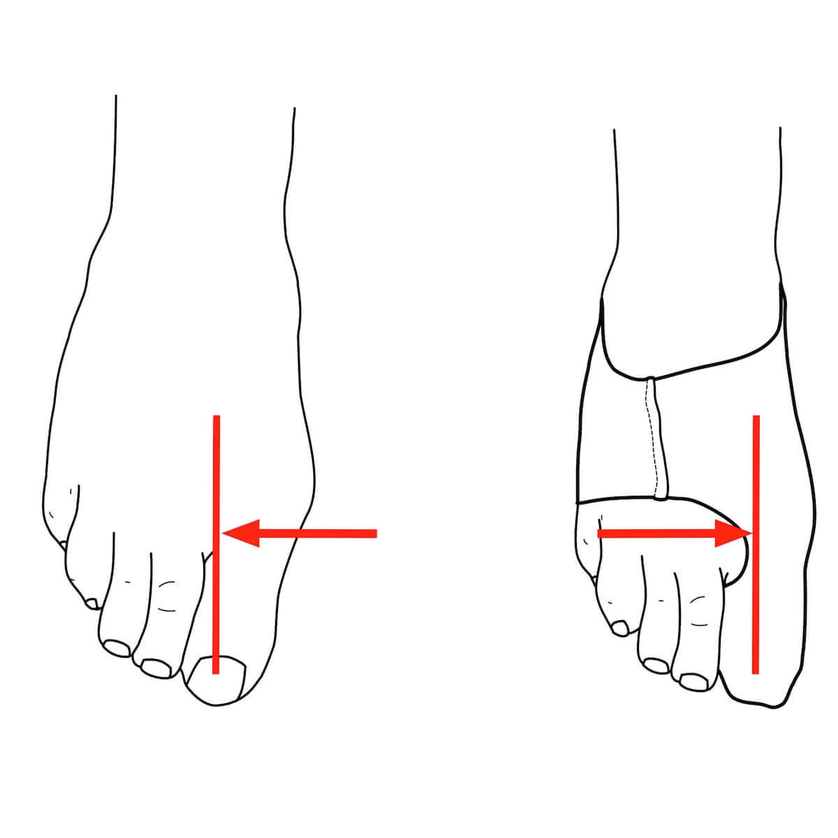 Diagram showing before and after effects of wearing bunion sleeve